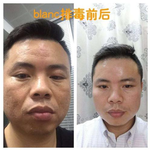 斑亮拉脸部排毒