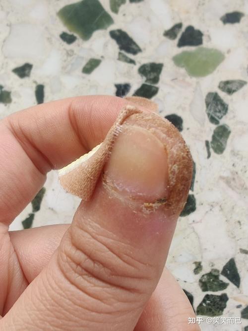 甲周疣自己治疗过程!