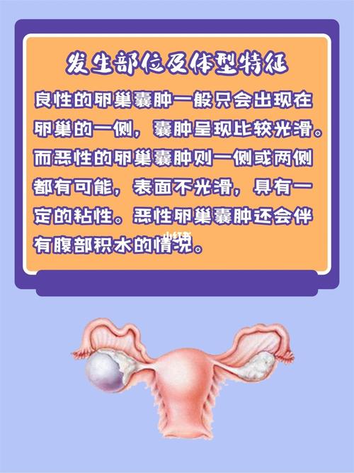卵巢囊肿_医疗