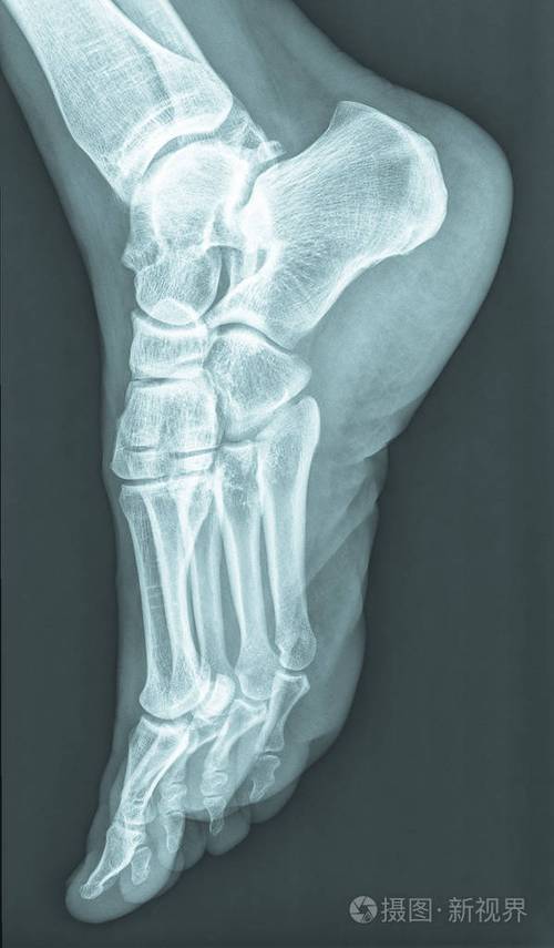 人类女性脚骨x线片