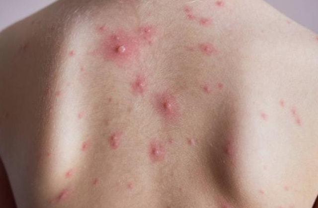 6,水痘脑炎的症状是什么?大多数水痘属于轻症,没有并发症.