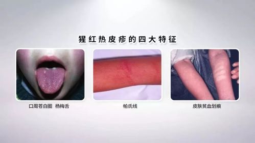 猩红热的皮疹为充血性鲜红色"鸡皮疙瘩"样细密的丘疹,在皮疹之间