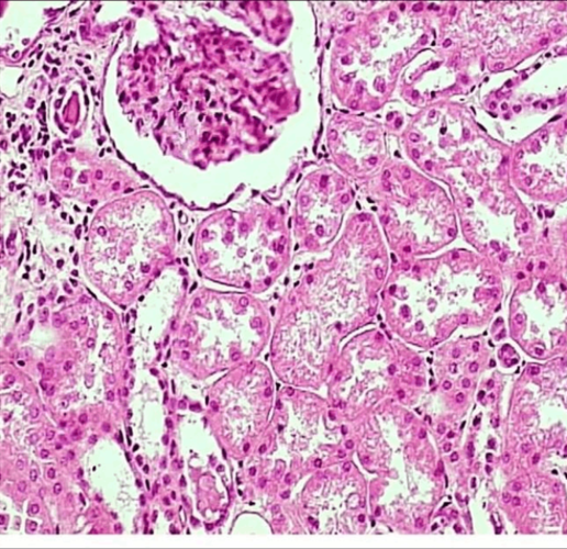 照片名称:肾水肿(1)