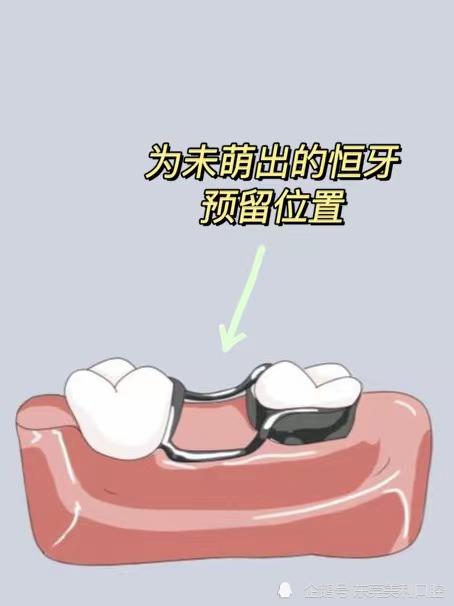 东莞美利口腔科普:儿童乳牙间隙保持器是什么?