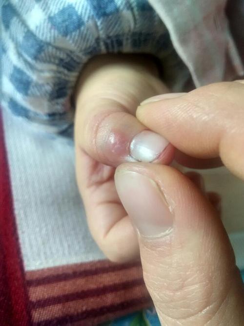 手指头上长了个小包,不知道是什么东西 手指头小包