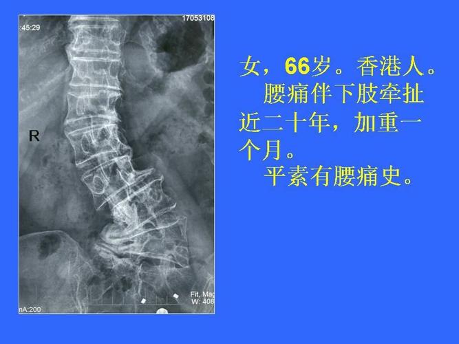 腰5楔型变 写美篇  x线片显示:腰5楔型变,腰椎侧弯,腰椎明显骨质增生