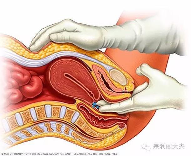妇检时触及阴道后穹窿触痛结节