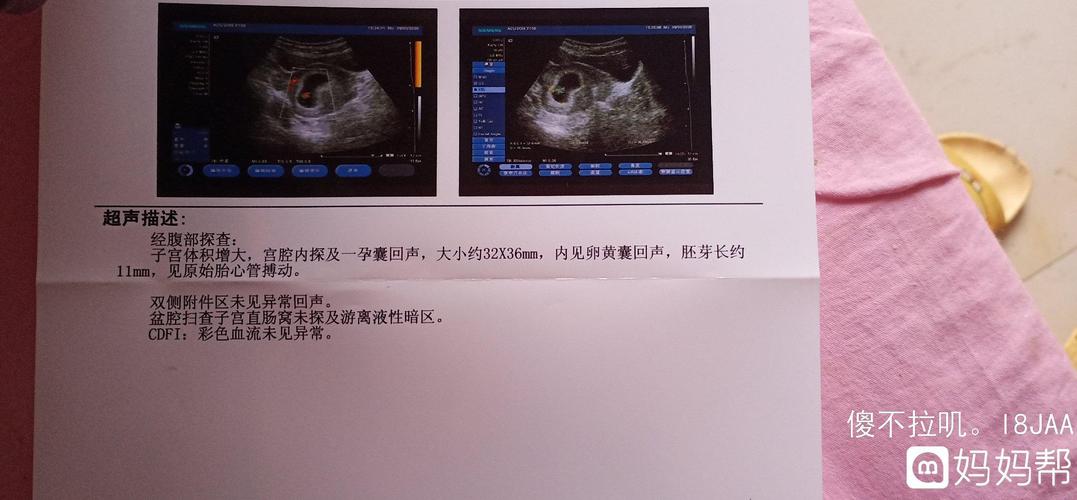 50几天孕囊32*36*11,麻烦会看的