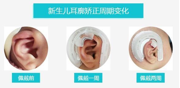 成都民生耳鼻喉医院新生儿耳廓畸形矫正好不好?无创bb