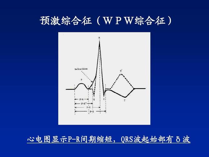 预激综合征(wpw综合征) 心电图显示p-r间期缩短,qrs波起始部有δ波