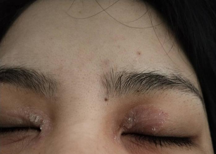 眼睛眼皮干燥脱皮怎么回事用什么药