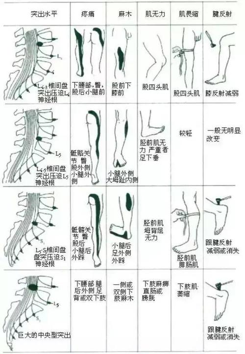 腰椎间盘突出症的临床表现