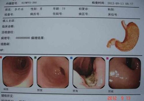 3,有明显上腹部饱胀感或摸到包块时,或是胃内存在癌病变现象.