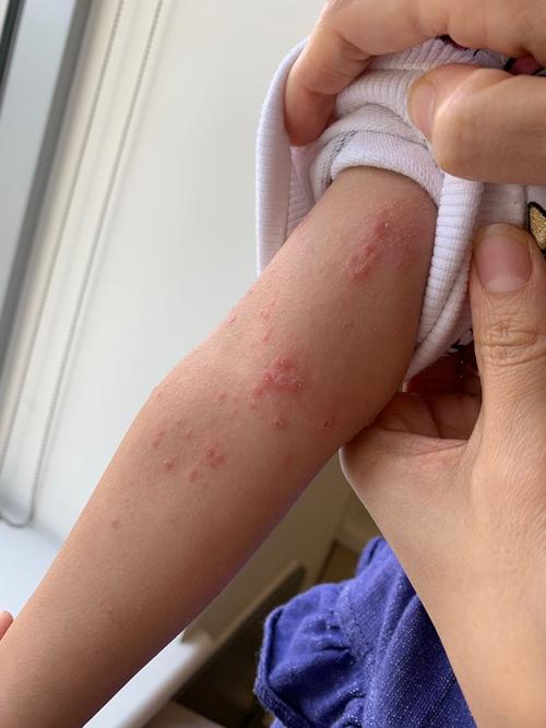 这个宝宝本来就有特应性皮炎 所以皮疹显得尤为严重,怪不得妈妈看不