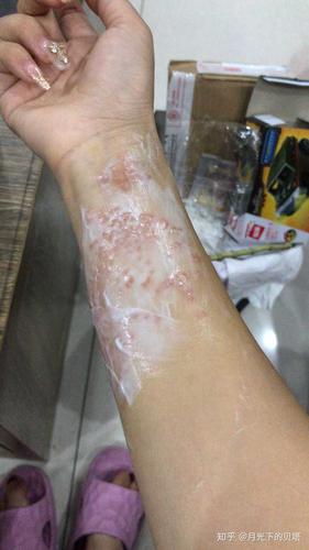 上周在巴厘岛潜水上来以后胳膊巨疼,被水母蛰了,当时教练说没事,回去