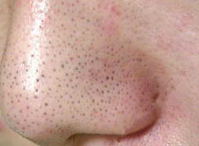 鼻子黑乎乎的粉刺,睡前用厨房的"它"涂脸,10分钟洗去黑头提亮肤色