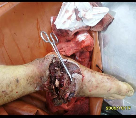 一,气性坏疽手术患者伤口的处理