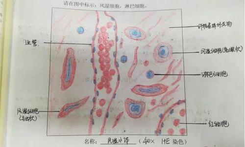 镜下观:在镜下可见呈均质红染玻璃样变性,肾小管内有均质红染的蛋白