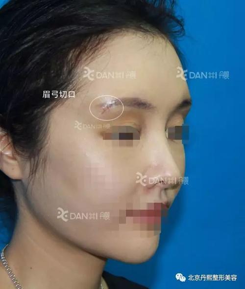 假体丰眉弓—整形教科书中未提及的手术 假体填充效果我们不一样