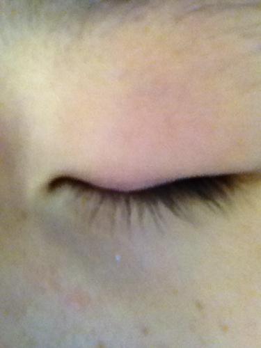 眼睛有些肿了,有点痛,请问这是什么情况,怎么治疗?