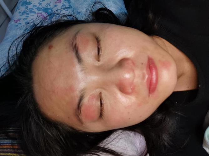 反复过敏,眼皮红肿脱皮,治疗了