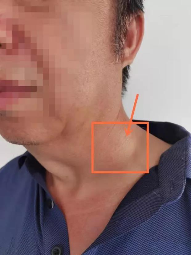 脖子长6厘米"疙瘩"原发病灶难寻,齐鲁医院青岛院区耳鼻咽喉头颈外科