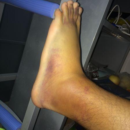 脚踝扭了,医生看看怎么办