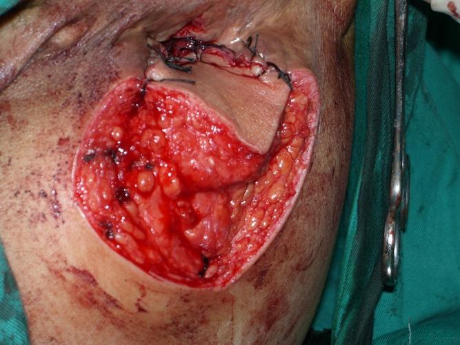 严重肛瘘切除后的图片