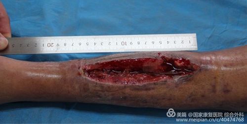 左胫骨骨髓炎国康医院骨一科一期治愈