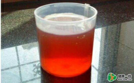 尿液有这变化当心暗示膀胱癌!