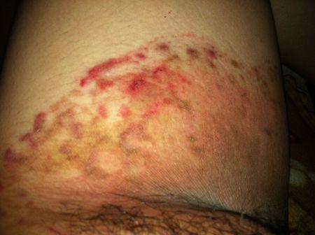 以前一直已湿疹在擦药膏,前段时间不知道大腿内侧怎么突然更痒了