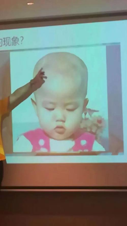 脾胃不和,钙吸收不足引起的四方颅