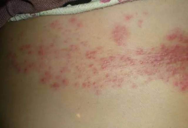 腰腹部疱疹