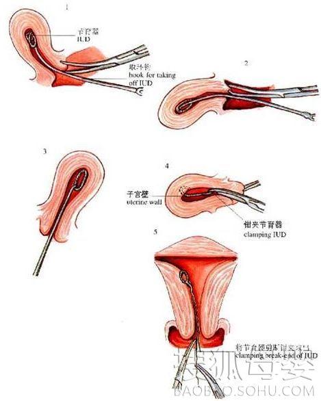 上环是什么意思_上环是什么意思图解_女性上