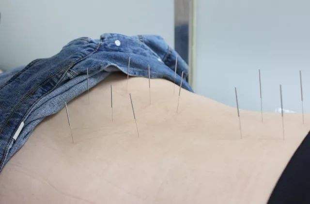 针灸减肥有副作用吗?