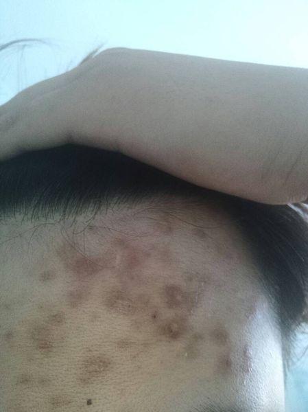 问:请问头上像这种是什么疙瘩 怎么才能好