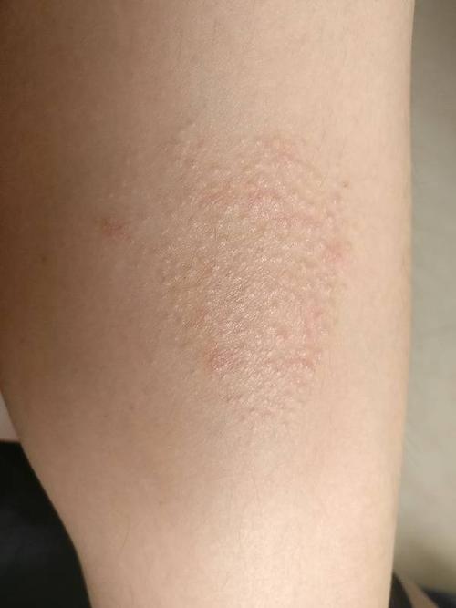 这是什么皮肤病 起初就是起鸡皮疙瘩似的 偶尔痒 抓一