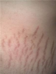 肥胖纹的等级划分,看看你的肥胖纹在第几等级