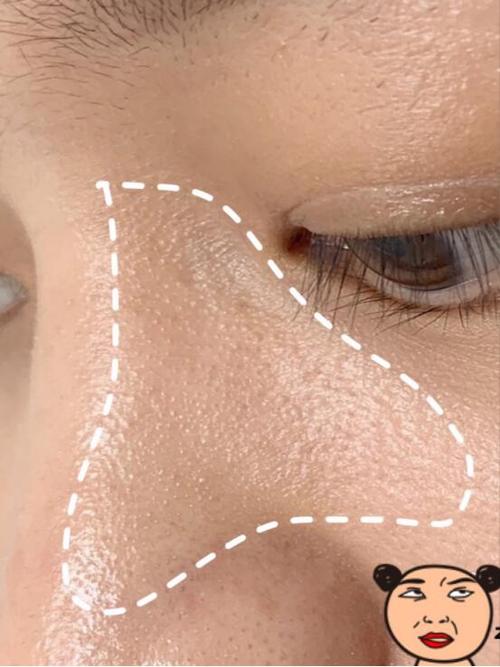 毛周角化长在脸颊两侧去除它适合什么洗面奶和水乳或者护肤品