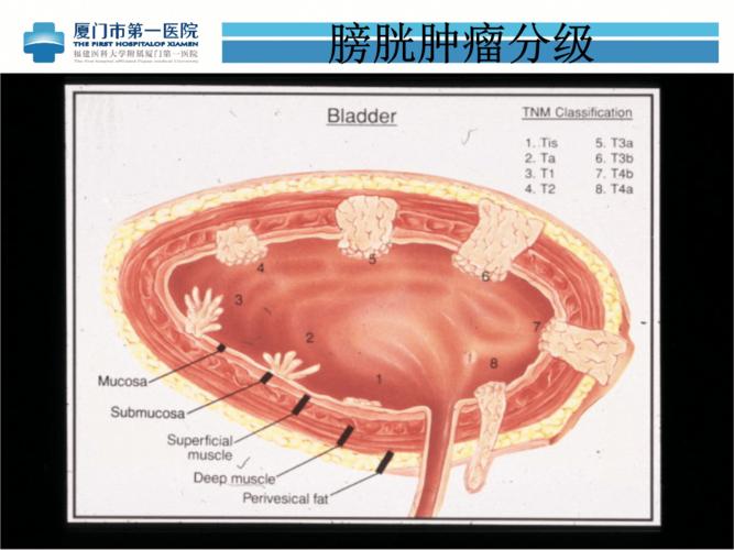 原位回肠新膀胱.ppt 34页