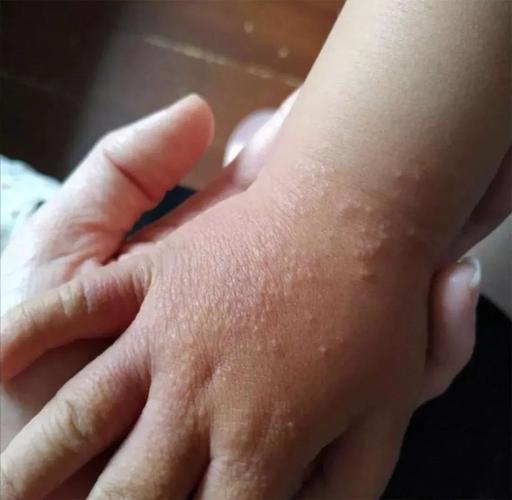 每个孩子都会出现的沙土皮炎