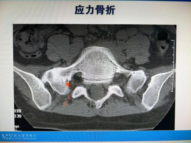 骨折的x线诊断