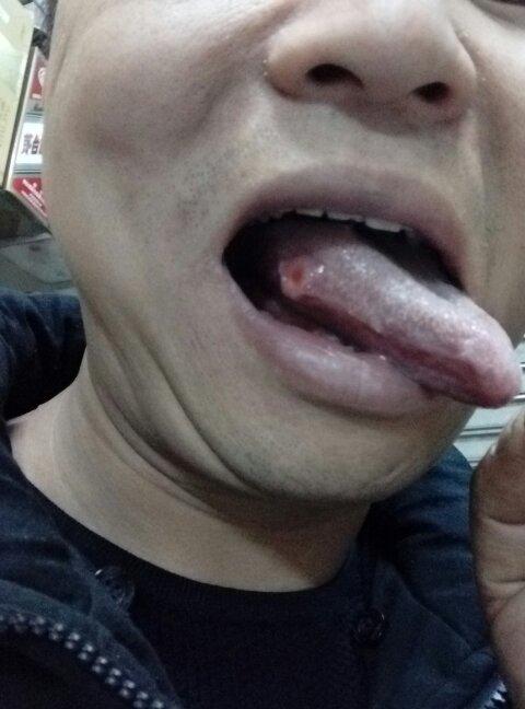 舌头生火泡都烂了一个洞要怎样治