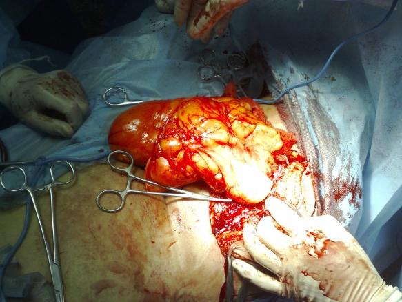 巨大脂肪瘤 要求加精