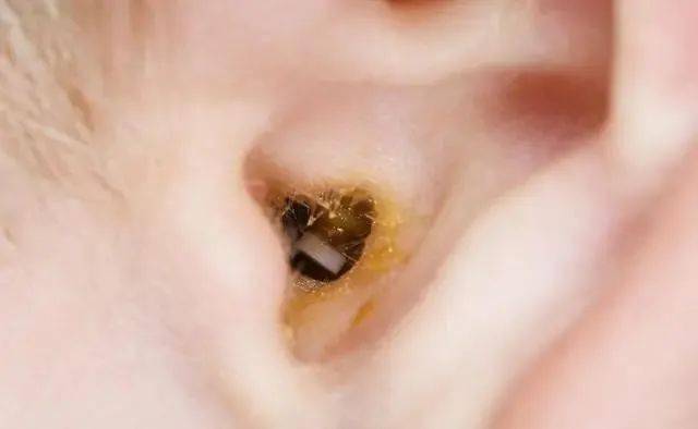 睡觉时耳朵流脓