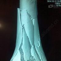 男45岁,胫骨远端粉碎性骨折