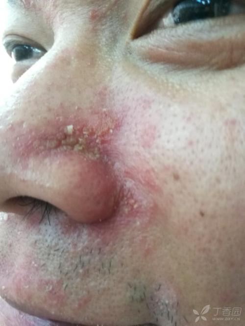 脸部长癣有五,六年了反复发作