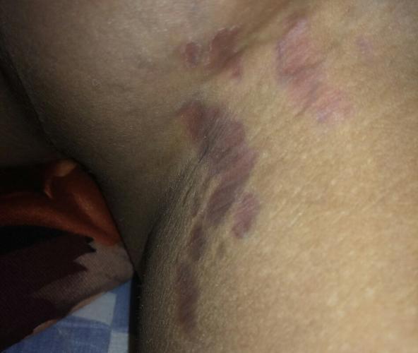 我大腿根部这是什么?是病吗?