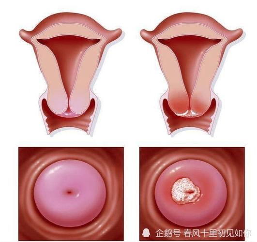 性生活和谐可以改善夫妻感情,如果得了子宫息肉,会影响女性朋友的性
