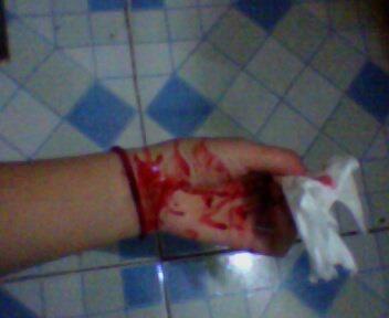 谁有手腕割伤的图片,真实一点的,有的话发给我,100财富